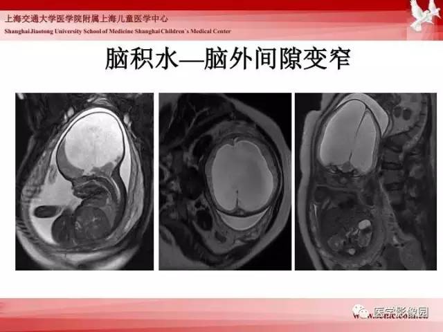 【PPT】胎儿神经系统MR检查规范与诊断思路