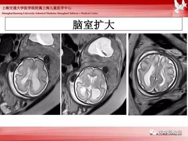 【PPT】胎儿神经系统MR检查规范与诊断思路