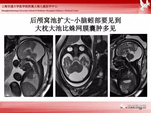 【PPT】胎儿神经系统MR检查规范与诊断思路