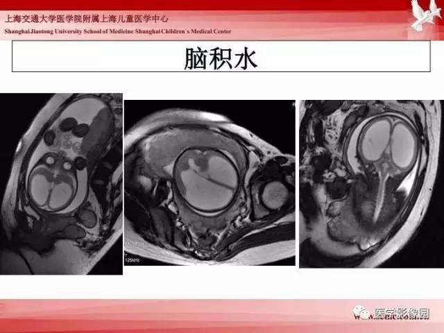 【PPT】胎儿神经系统MR检查规范与诊断思路