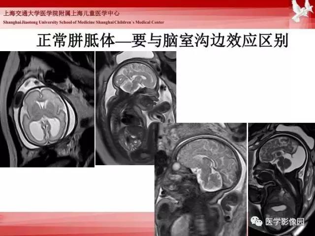 【PPT】胎儿神经系统MR检查规范与诊断思路