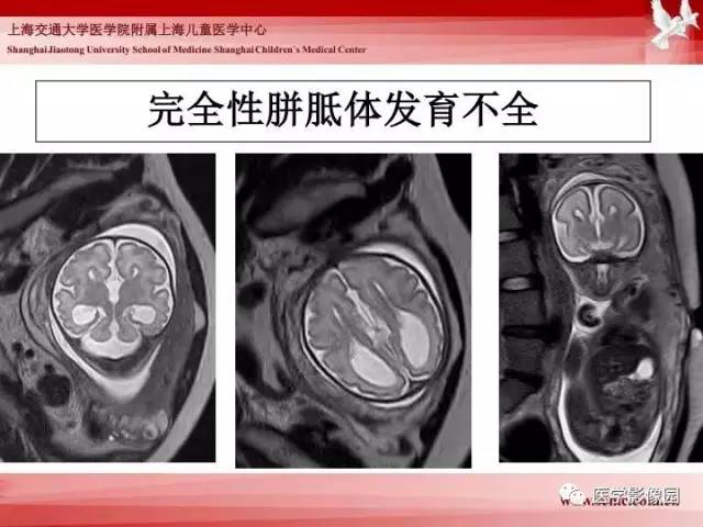 【PPT】胎儿神经系统MR检查规范与诊断思路
