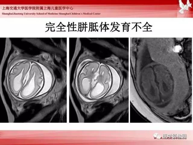 【PPT】胎儿神经系统MR检查规范与诊断思路