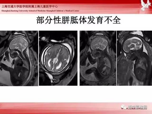 【PPT】胎儿神经系统MR检查规范与诊断思路