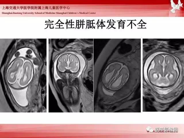 【PPT】胎儿神经系统MR检查规范与诊断思路