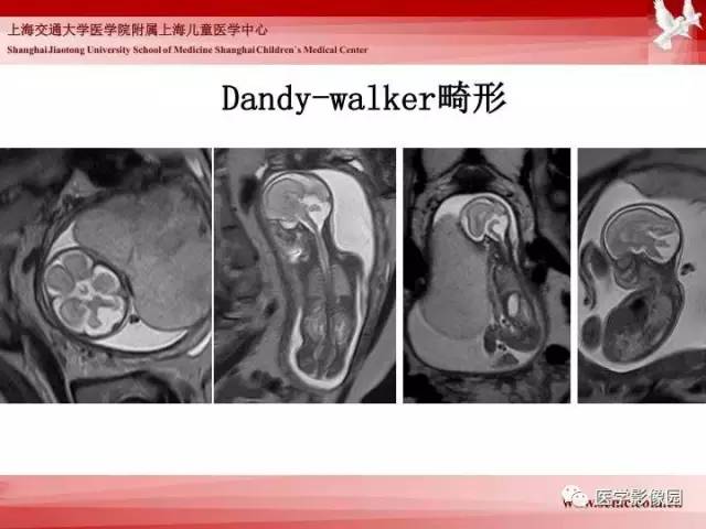 【PPT】胎儿神经系统MR检查规范与诊断思路