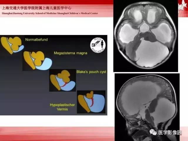 【PPT】胎儿神经系统MR检查规范与诊断思路