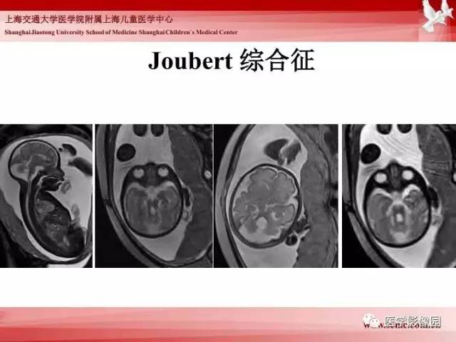 【PPT】胎儿神经系统MR检查规范与诊断思路