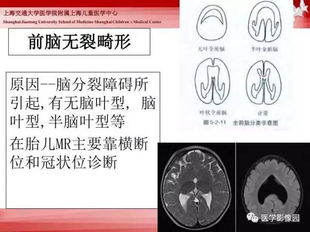 【PPT】胎儿神经系统MR检查规范与诊断思路