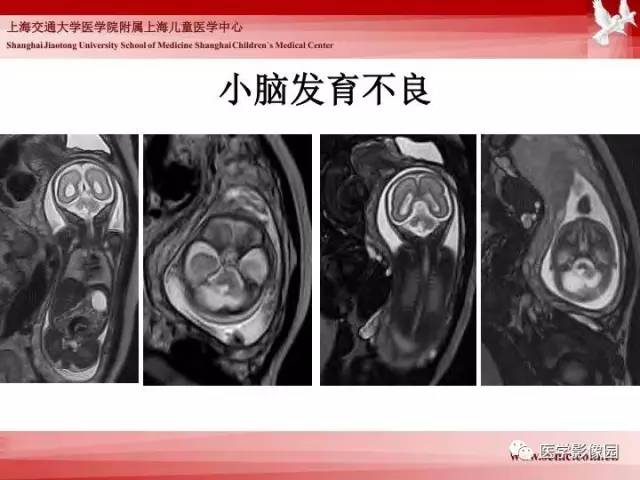 【PPT】胎儿神经系统MR检查规范与诊断思路