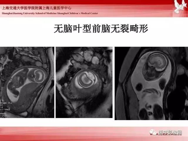 【PPT】胎儿神经系统MR检查规范与诊断思路