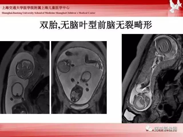 【PPT】胎儿神经系统MR检查规范与诊断思路