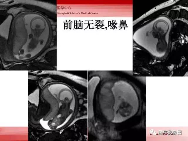 【PPT】胎儿神经系统MR检查规范与诊断思路