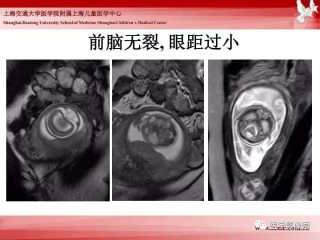 【PPT】胎儿神经系统MR检查规范与诊断思路