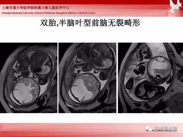 【PPT】胎儿神经系统MR检查规范与诊断思路