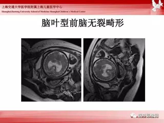【PPT】胎儿神经系统MR检查规范与诊断思路