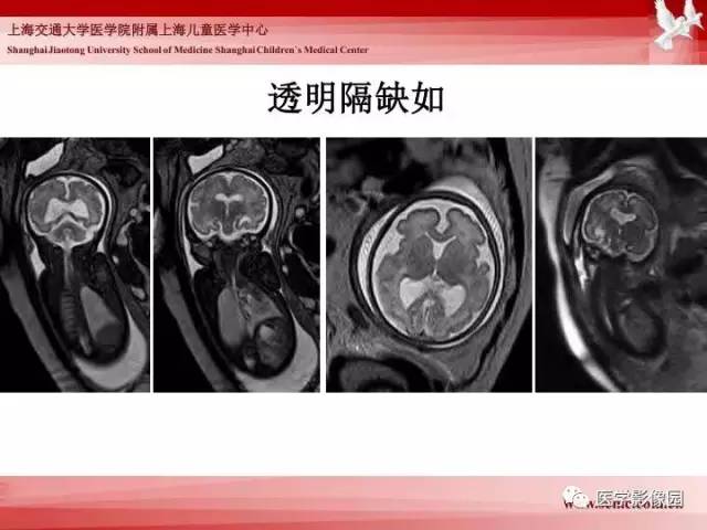【PPT】胎儿神经系统MR检查规范与诊断思路