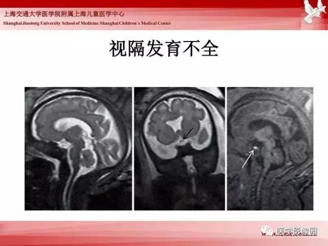 【PPT】胎儿神经系统MR检查规范与诊断思路