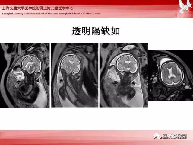 【PPT】胎儿神经系统MR检查规范与诊断思路