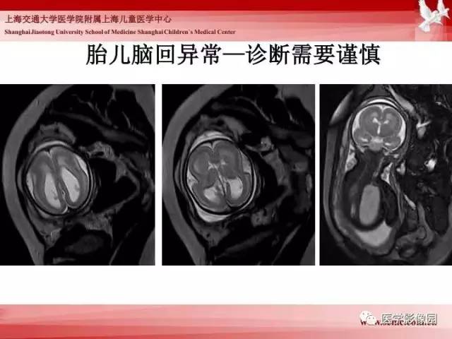 【PPT】胎儿神经系统MR检查规范与诊断思路