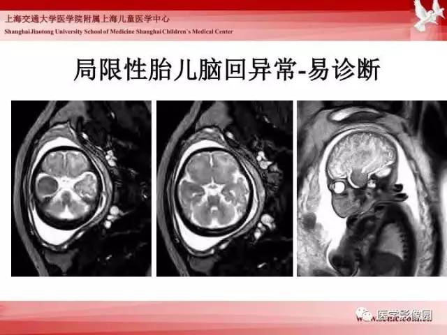 【PPT】胎儿神经系统MR检查规范与诊断思路