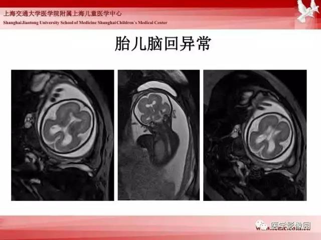 【PPT】胎儿神经系统MR检查规范与诊断思路