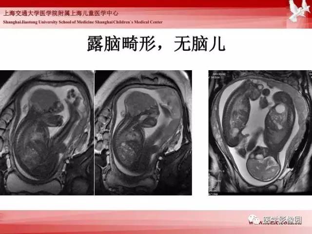 【PPT】胎儿神经系统MR检查规范与诊断思路