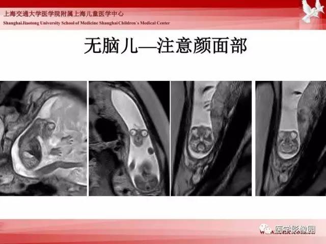 【PPT】胎儿神经系统MR检查规范与诊断思路