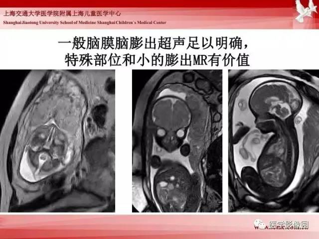 【PPT】胎儿神经系统MR检查规范与诊断思路