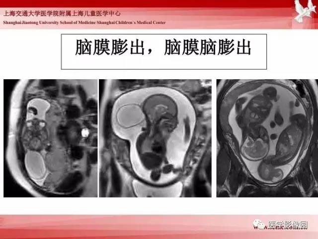 【PPT】胎儿神经系统MR检查规范与诊断思路