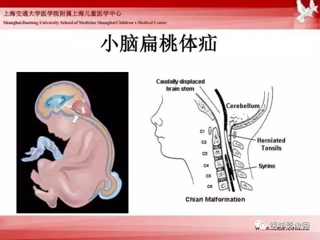 【PPT】胎儿神经系统MR检查规范与诊断思路