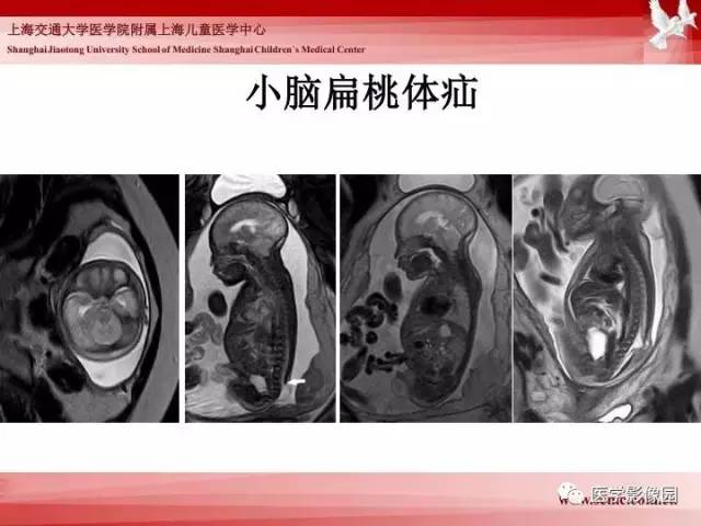 【PPT】胎儿神经系统MR检查规范与诊断思路