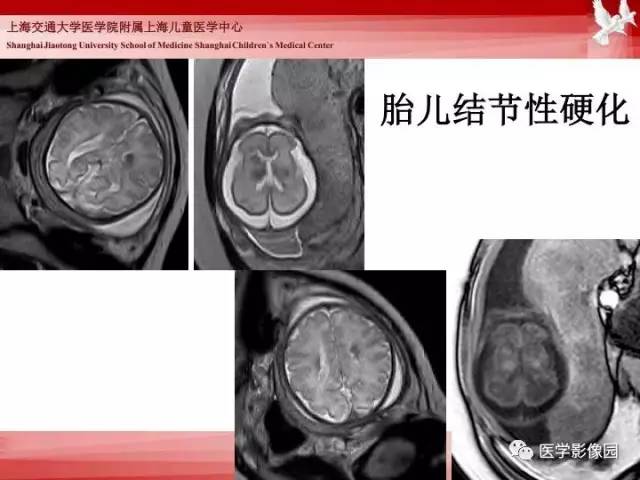 【PPT】胎儿神经系统MR检查规范与诊断思路
