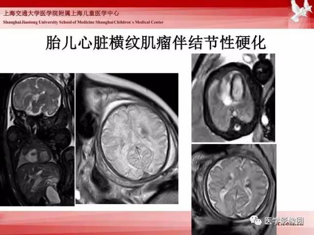 【PPT】胎儿神经系统MR检查规范与诊断思路