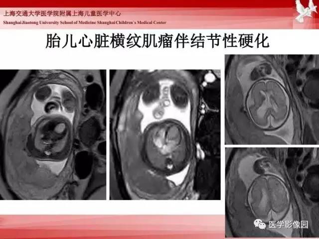 【PPT】胎儿神经系统MR检查规范与诊断思路