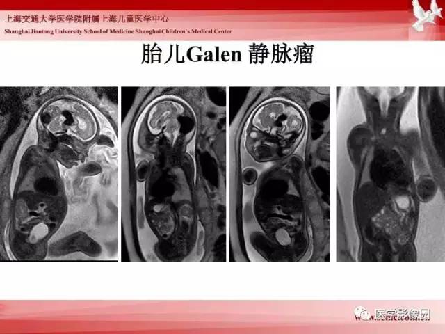 【PPT】胎儿神经系统MR检查规范与诊断思路