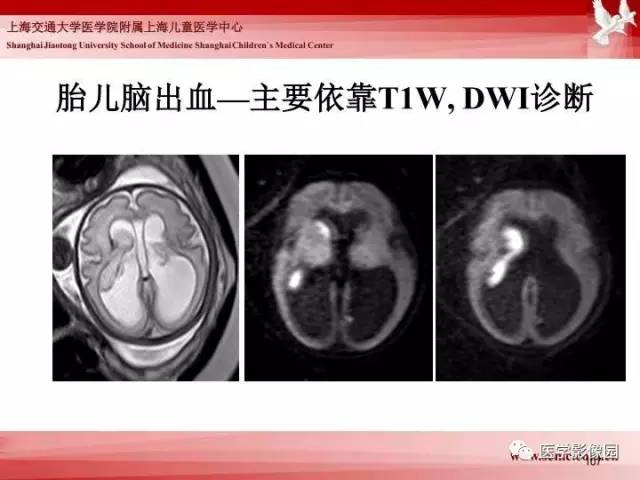 【PPT】胎儿神经系统MR检查规范与诊断思路