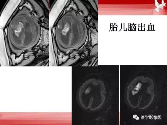 【PPT】胎儿神经系统MR检查规范与诊断思路