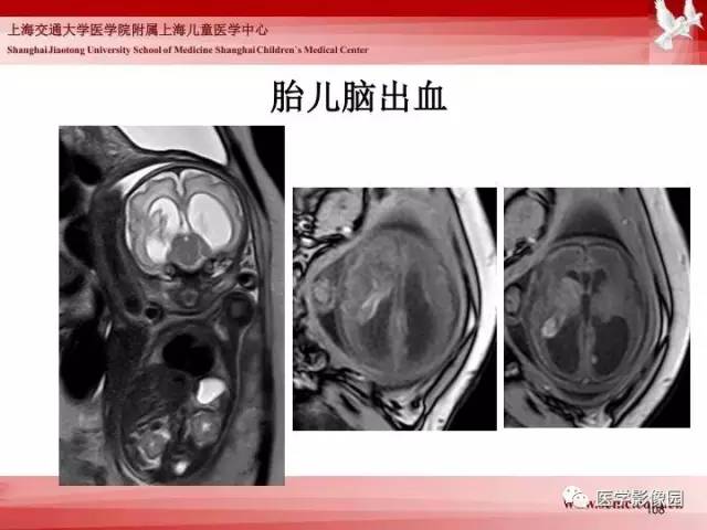 【PPT】胎儿神经系统MR检查规范与诊断思路