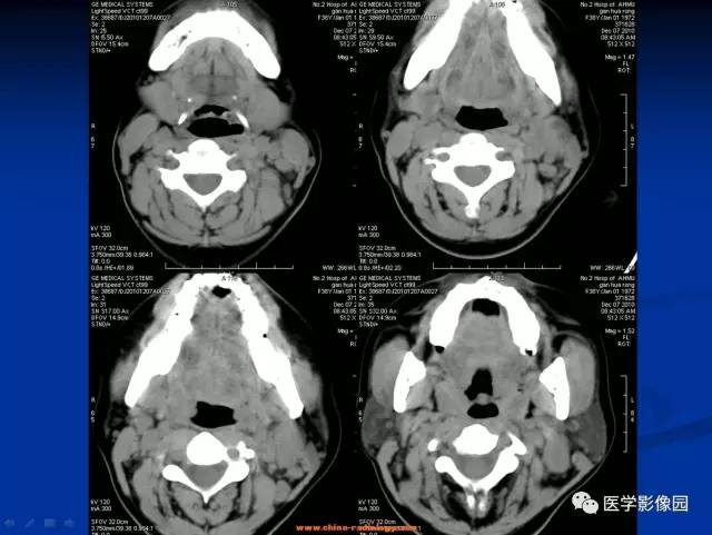 【病例】猫抓病所致淋巴结炎1例CT影像表现 【病例】猫抓病所致淋巴结炎1例CT影像表现