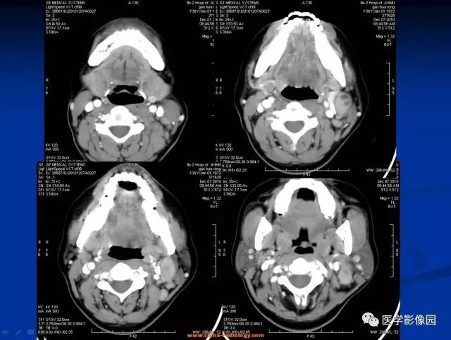 【病例】猫抓病所致淋巴结炎1例CT影像表现 【病例】猫抓病所致淋巴结炎1例CT影像表现