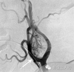"里尔琴征"，这个征象提示啥？