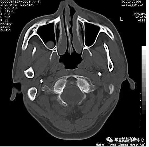 一图记忆鼻窦常见囊性病变