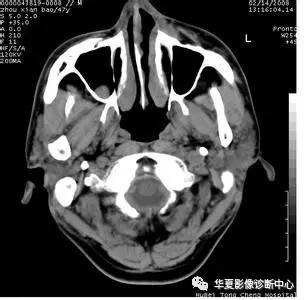 一图记忆鼻窦常见囊性病变