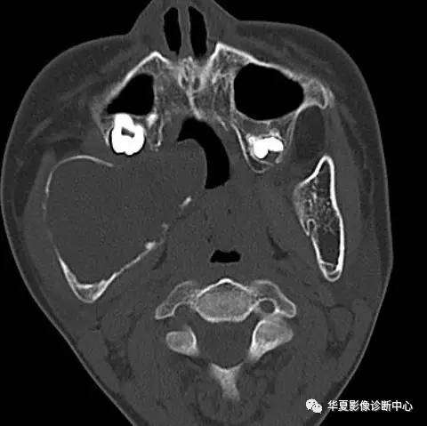 一图记忆鼻窦常见囊性病变