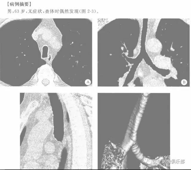 剑鞘状气管