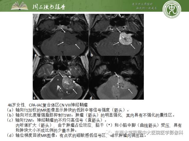 【PPT】颅神经神经鞘瘤：影像学诊断方法