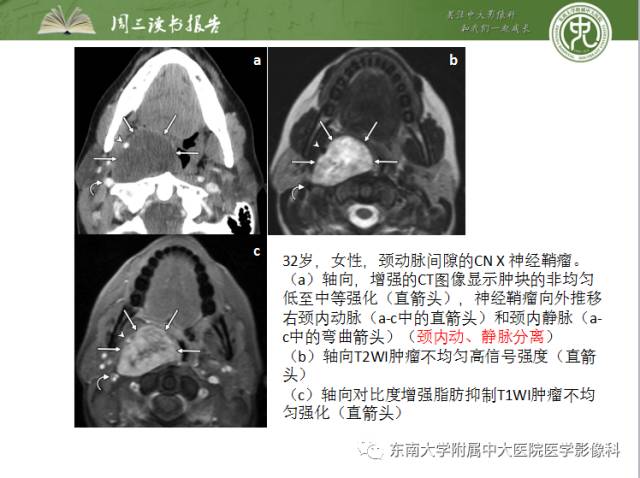 【PPT】颅神经神经鞘瘤：影像学诊断方法