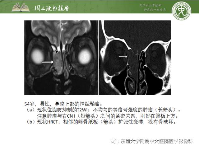 【PPT】颅神经神经鞘瘤：影像学诊断方法