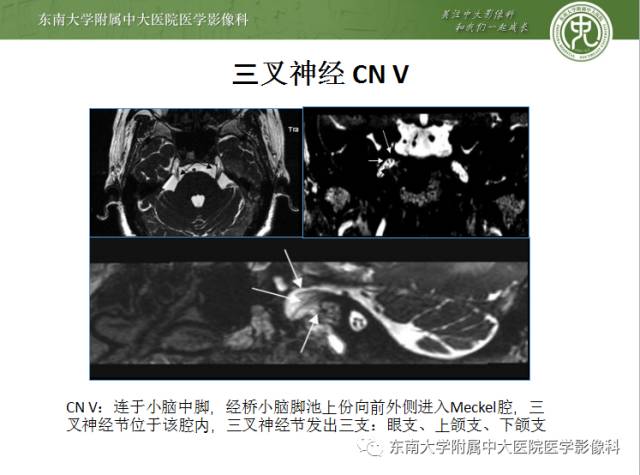 【PPT】颅神经神经鞘瘤：影像学诊断方法